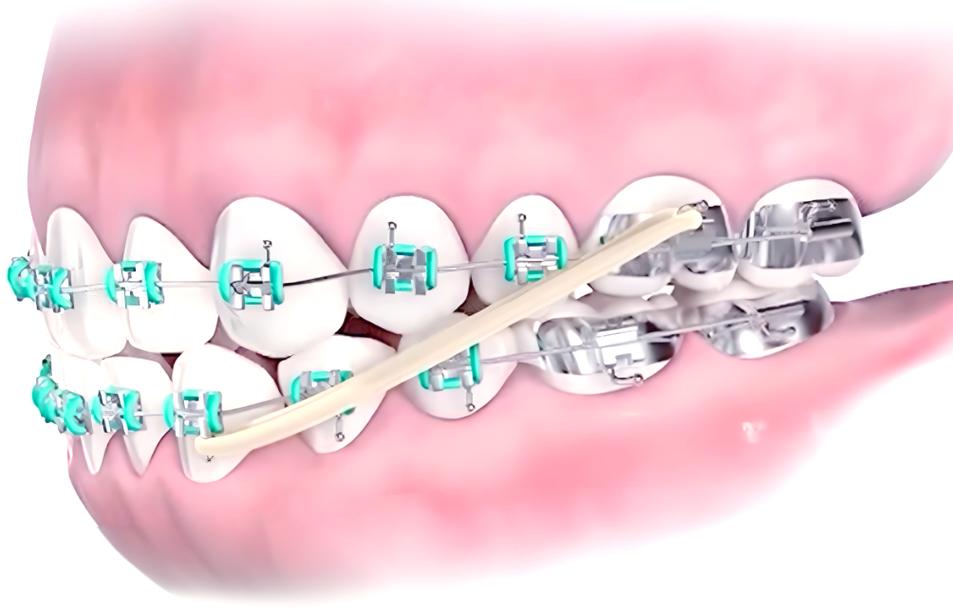 牙齿矫正皮筋中线-图1