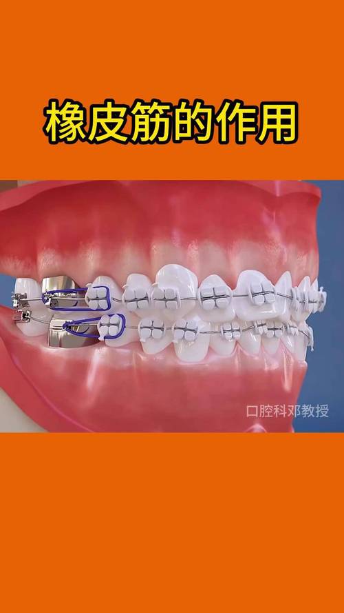 牙齿矫正皮筋中线-图2