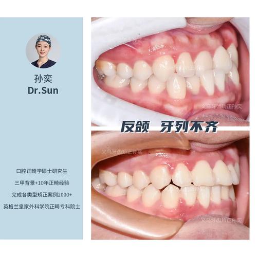 牙齿错位矫正案例中矫正效果如何体现?-图1 牙齿错位矫正案例中矫正效果如何体现?-图1