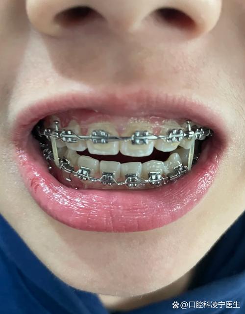 矫正牙齿嘴巴突出是什么原因？该如何有效改善？-图1