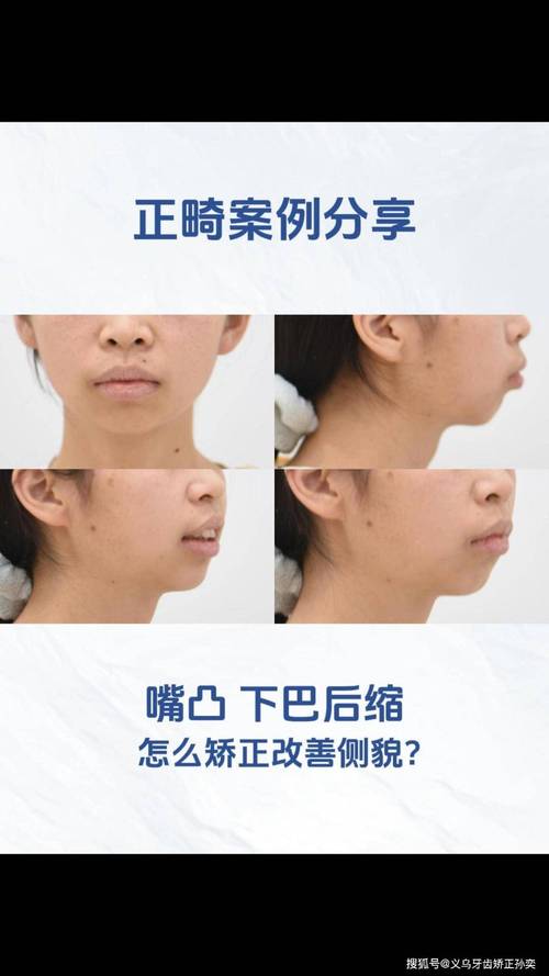 矫正牙齿嘴巴突出是什么原因？该如何有效改善？-图3