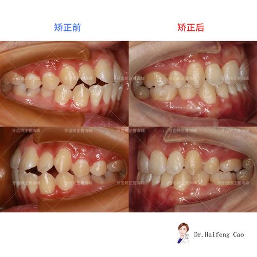 牙齿缺失矫正牙齿-图3