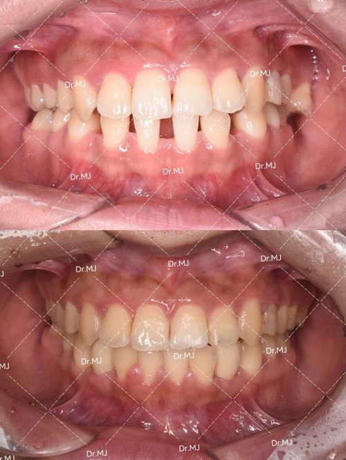 牙齿缺失矫正牙齿-图2