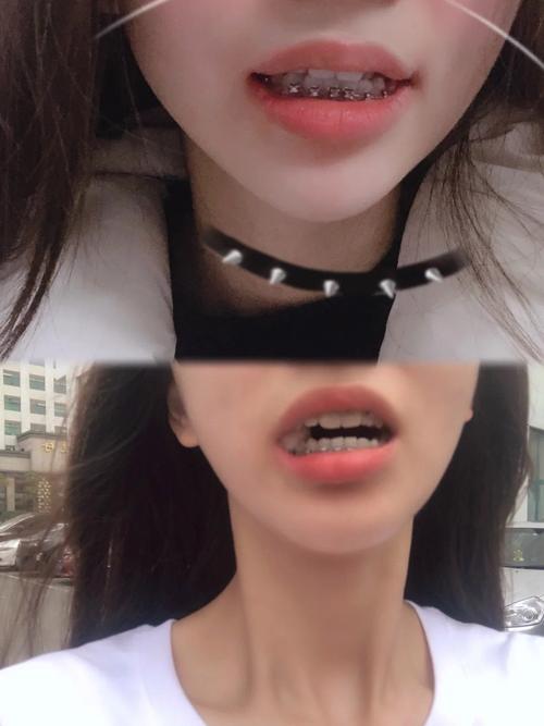 女孩牙齿矫正图片能直观展示矫正前后的牙齿变化吗?-图1 女孩牙齿矫正图片能直观展示矫正前后的牙齿变化吗?-图1