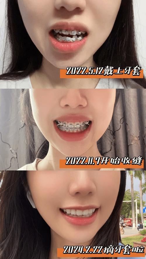 女孩牙齿矫正图片能直观展示矫正前后的牙齿变化吗?-图3 女孩牙齿矫正图片能直观展示矫正前后的牙齿变化吗?-图3