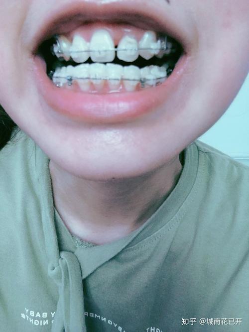 20岁后矫正牙齿,年龄会影响矫正效果吗?-图1 20岁后矫正牙齿,年龄会影响矫正效果吗?-图1