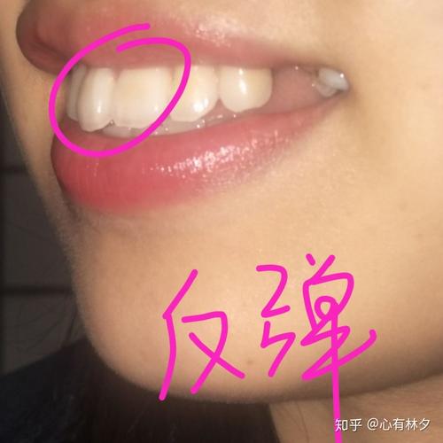 矫正过的牙齿为何会反弹？如何科学预防反弹？-图2