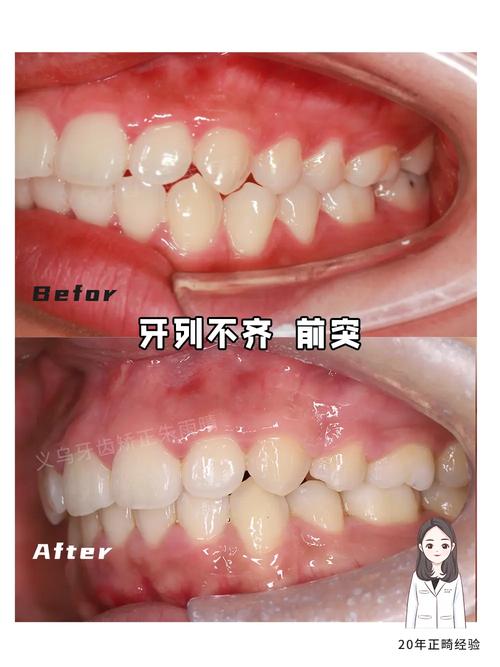 牙齿矫正中线不齐？原因何在或如何调整？-图1