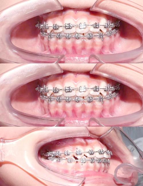 康圆口腔矫正牙齿效果如何？性价比高吗？-图2