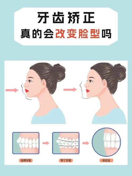 矫正牙齿能瘦脸吗-图3 矫正牙齿能瘦脸吗-图3