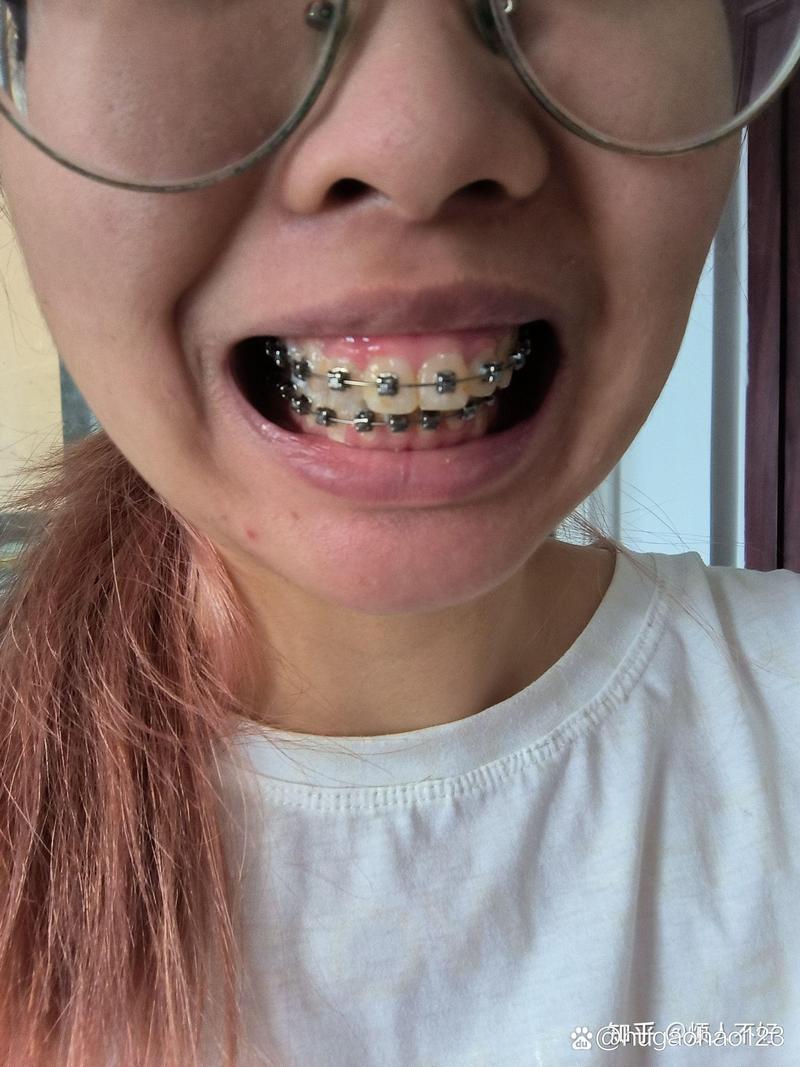 上海龅牙矫正怎么选?效果靠谱吗?费用多少?-图3 上海龅牙矫正怎么选?效果靠谱吗?费用多少?-图3