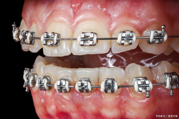 金属牙齿矫正图片-图3