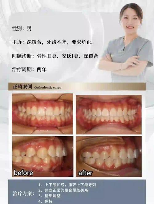 牙齿矫正脸型对比，矫正前后脸型变化有多大？对比图揭秘！-图2