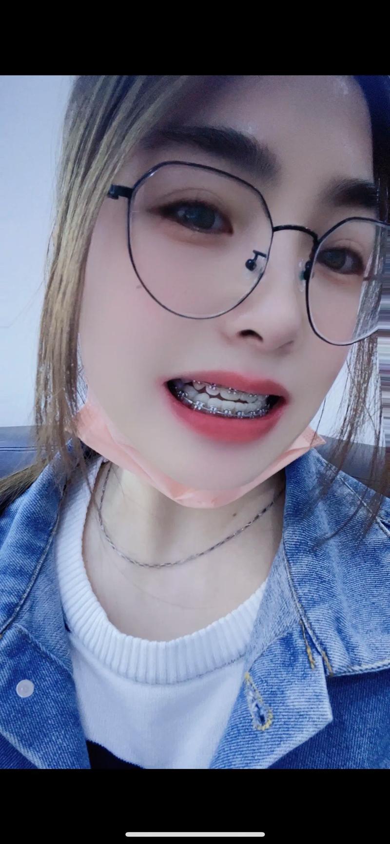 30岁后矫正牙齿-图2