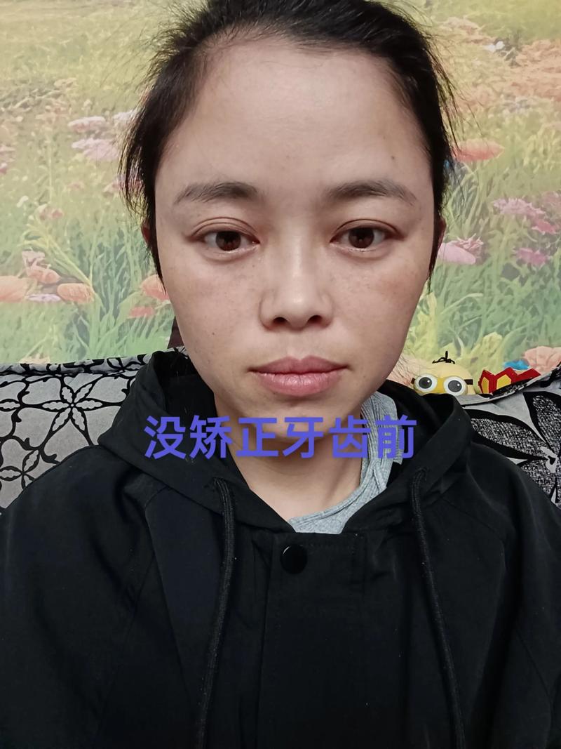 30岁后矫正牙齿-图1