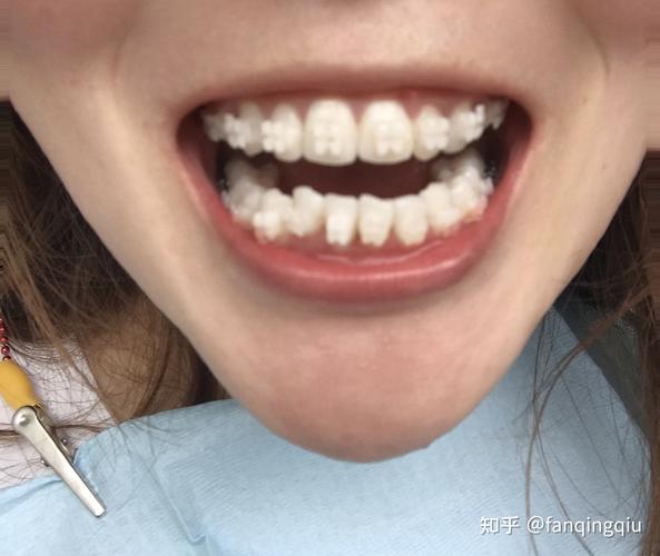 27岁做牙齿矫正-图1
