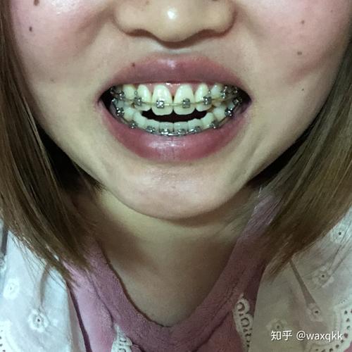 27岁做牙齿矫正-图2