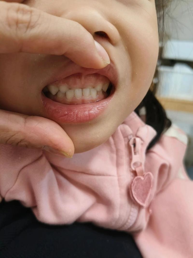 不戴牙套矫正牙齿效果如何？具体方法有哪些？-图1