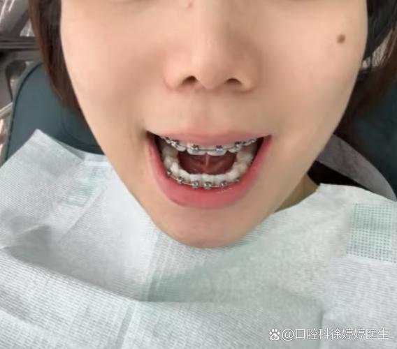 矫正牙齿不戴牙套？有哪些可行方法？效果如何？-图2