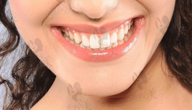 维多利亚牙齿矫正-图2