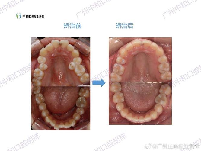 广州哪里矫正牙齿效果好又靠谱？-图3