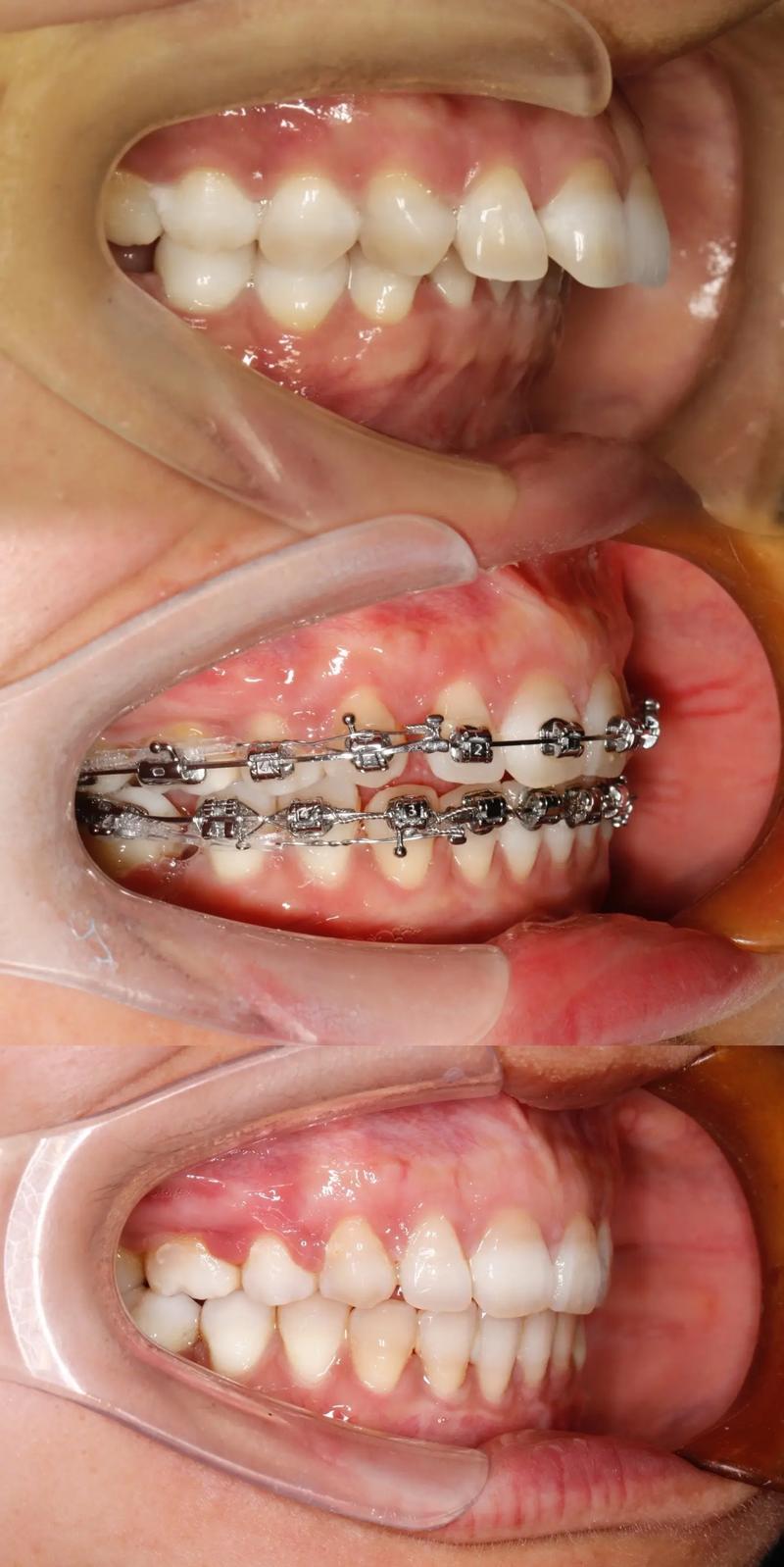 矫正牙齿不带牙套？如何有效矫正？-图3