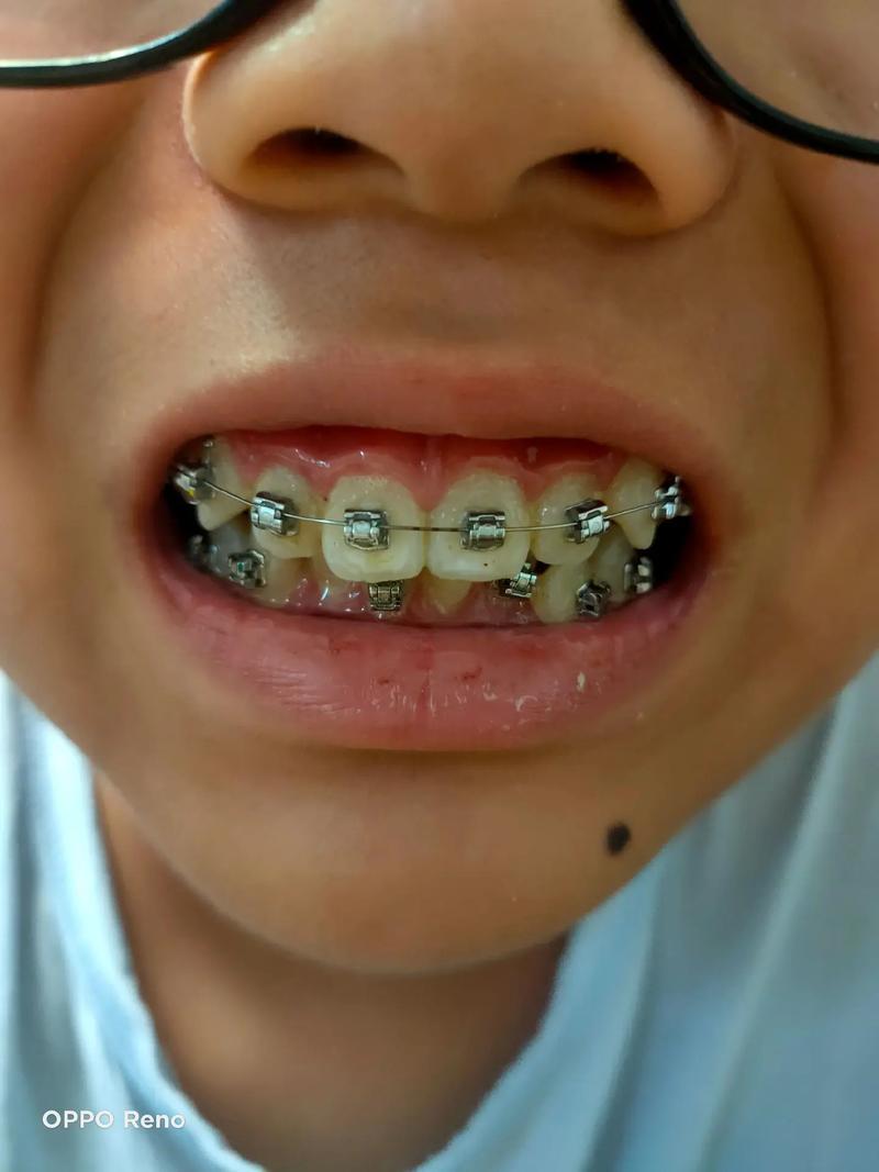 矫正牙齿不带牙套？如何有效矫正？-图2