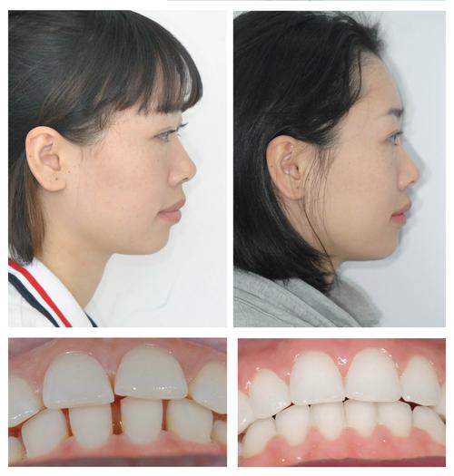 穗华口腔牙齿矫正效果如何？价格值得信赖吗？-图1