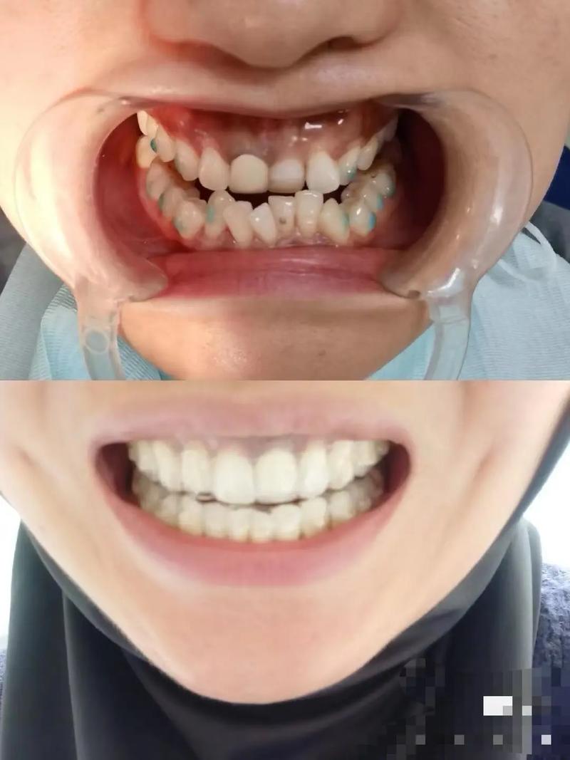 牙齿矫正前后照片对比，效果究竟有多让人惊叹？-图2