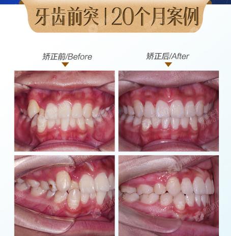 成都牙齿矫正哪家好？这些因素要重点关注！-图2