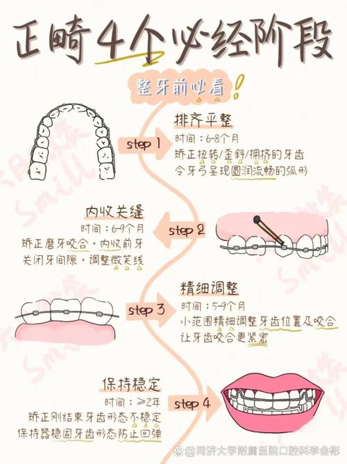 牙齿矫正的过程是怎样的？包含哪些关键步骤和科学原理？-图3