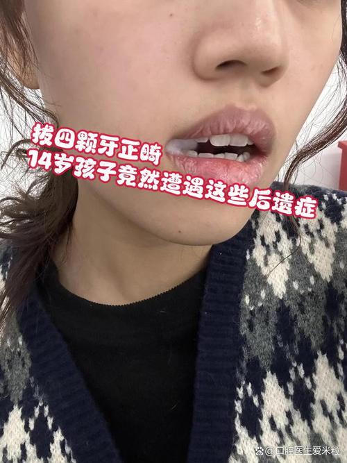 矫正牙齿拔四颗牙，真的有必要吗？会有啥影响？-图2