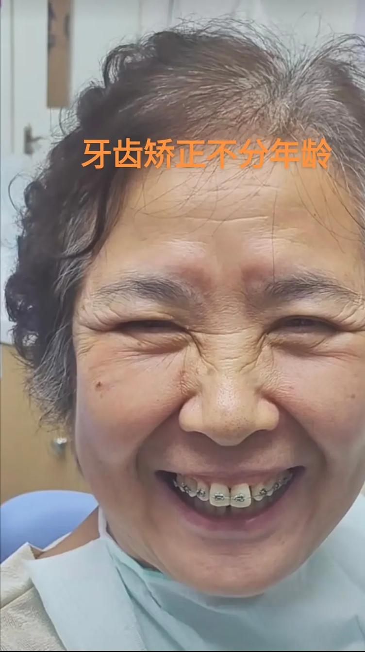 小孩矫正牙齿的最佳年龄是几岁?-图3 小孩矫正牙齿的最佳年龄是几岁?-图3