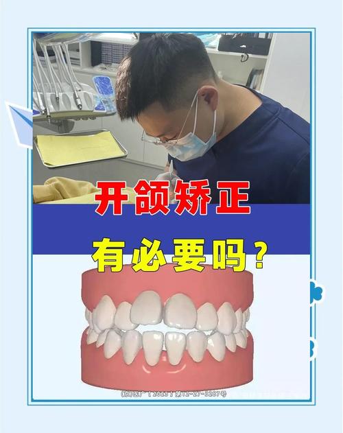 牙齿开颌怎么矫正？有哪些方法？-图2