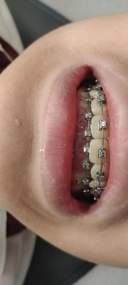 儿童牙齿矫正拔牙-图1 儿童牙齿矫正拔牙-图1