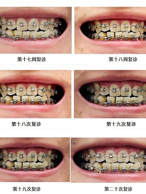 牙齿矫正真有后遗症？具体有哪些表现？-图3