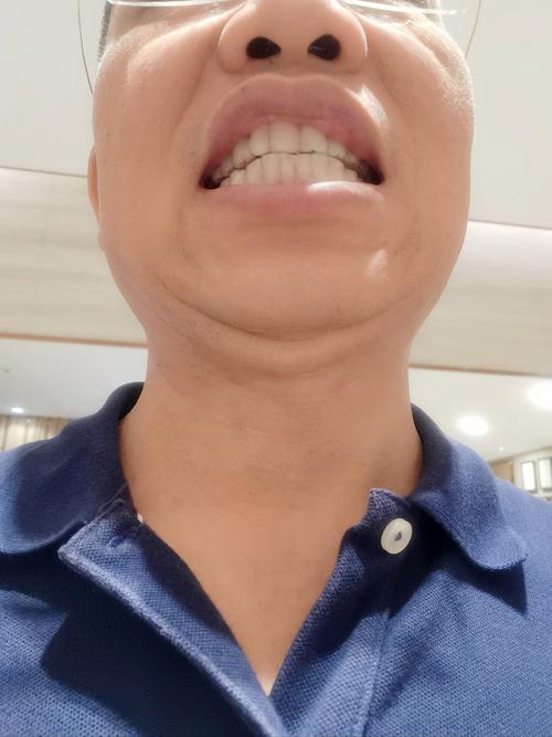 乌鲁木齐牙齿矫正-图1 乌鲁木齐牙齿矫正-图1