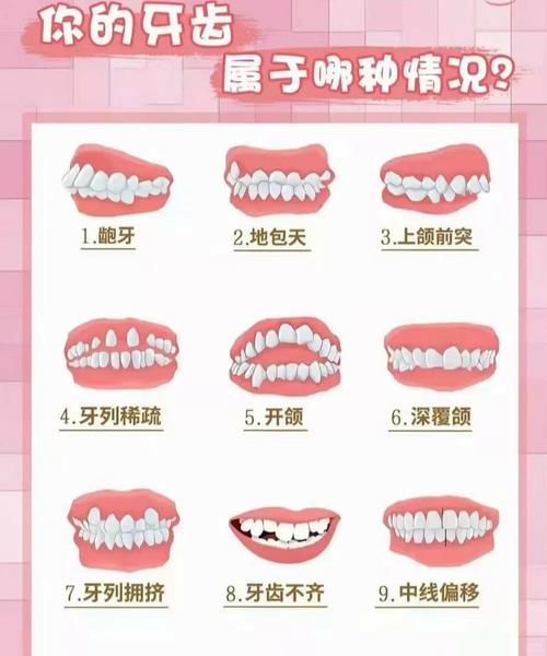 牙齿矫正有哪几种常见类型?各自适用哪些情况?-图2 牙齿矫正有哪几种常见类型?各自适用哪些情况?-图2