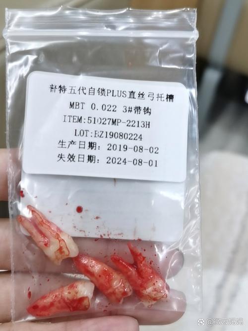 牙齿矫正拔四颗牙-图2