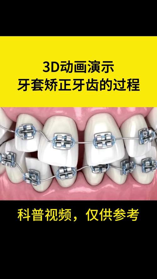 牙齿矫正过程视频,真实过程到底如何呢?-图1 牙齿矫正过程视频,真实过程到底如何呢?-图1