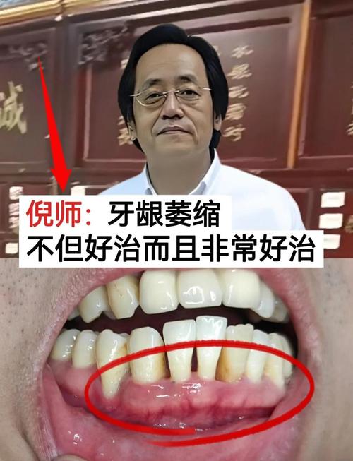 矫正牙齿牙龈萎缩-图3