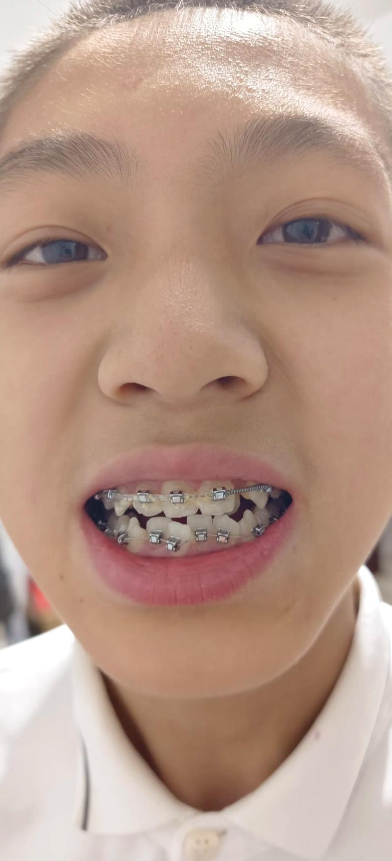 牙齿非常乱，矫正真的能变整齐吗？效果好不好？要多久？-图3