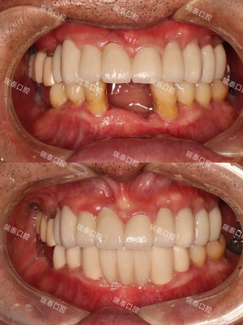 矫正牙齿前修复-图1