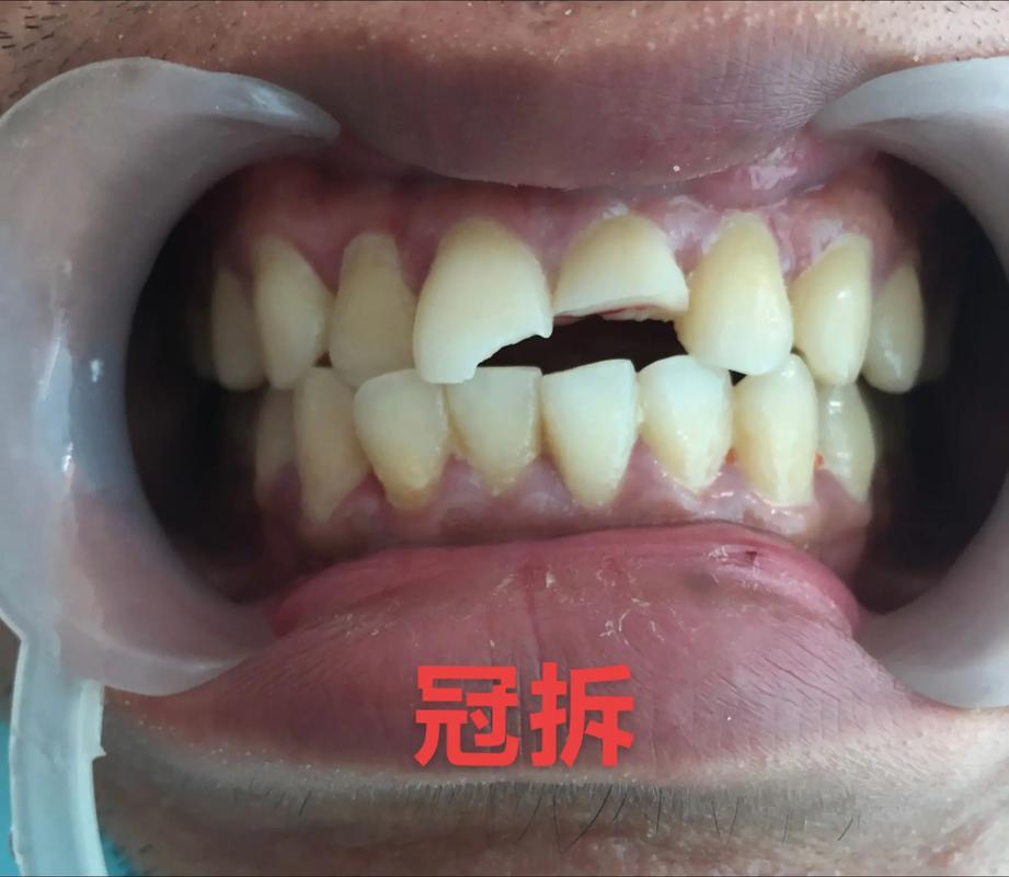 矫正牙齿前修复-图2