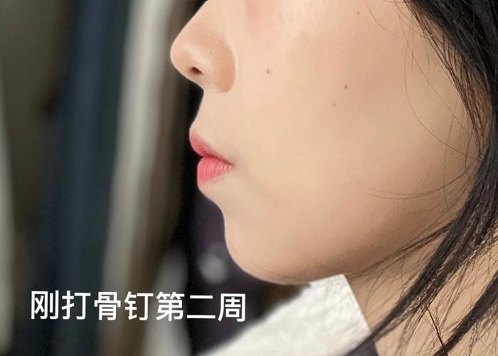 嘴巴大牙齿矫正-图3