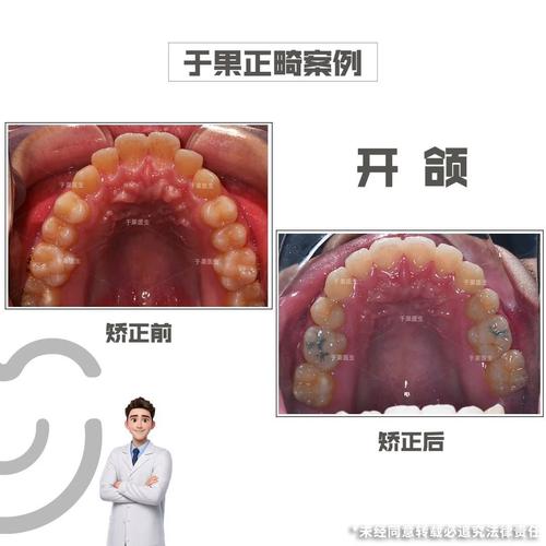 下巴响矫正牙齿-图1 下巴响矫正牙齿-图1