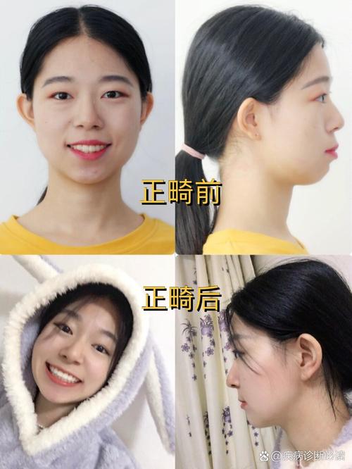 牙齿前突矫正怎么做?效果好吗?有哪些注意事项?要多久?-图1 牙齿前突矫正怎么做?效果好吗?有哪些注意事项?要多久?-图1