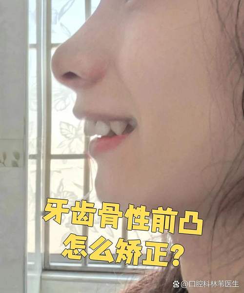 牙齿前突矫正怎么做?效果好吗?有哪些注意事项?要多久?-图2 牙齿前突矫正怎么做?效果好吗?有哪些注意事项?要多久?-图2