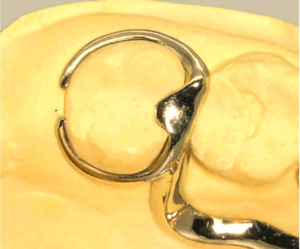 牙齿矫正上卡环-图1 牙齿矫正上卡环-图1