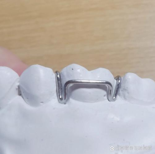 牙齿矫正上卡环-图2 牙齿矫正上卡环-图2